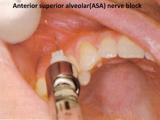 www.themegallery.com
Anterior superior alveolar(ASA) nerve block
 