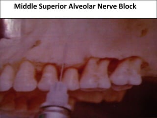 www.themegallery.com
Middle Superior Alveolar Nerve Block
 