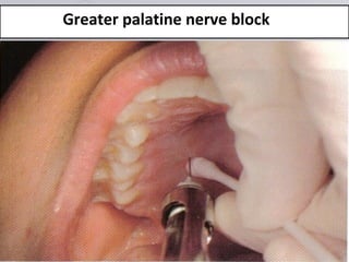www.themegallery.com
Greater palatine nerve block
 