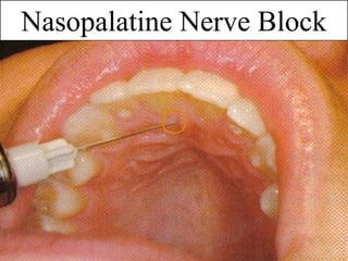 www.themegallery.com
Nasopalatine Nerve Block
 