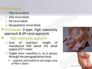 www.themegallery.com
Alternatives
1. PSA nerve block
2. ASA nerve block
3. GP nerve block
4. Nasopalatine nerve block
Technique– 2-type: high tuberosity
approach & GP canal approach
 High-tuberosity approach
1. Area of insertion– height of
mucobuccal fold above the distal
aspect of 2nd
molar
2. Target area– maxillary n. as it passes
through the pterygopalatine fossa
• superior and medial to the target area
of PSA n. block
 