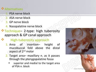 www.themegallery.com
Alternatives
1. PSA nerve block
2. ASA nerve block
3. GP nerve block
4. Nasopalatine nerve block
Te...