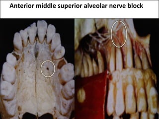www.themegallery.com
Anterior middle superior alveolar nerve block
 
