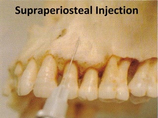 www.themegallery.com
Supraperiosteal Injection
 