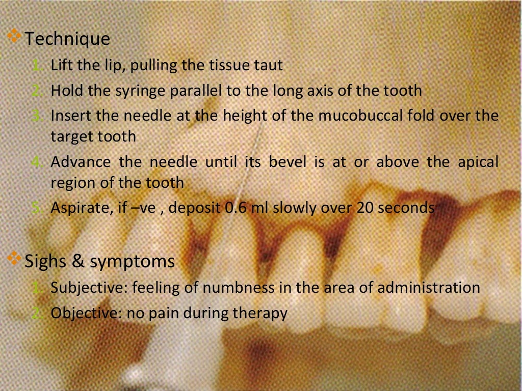 maxillary nerve blocks