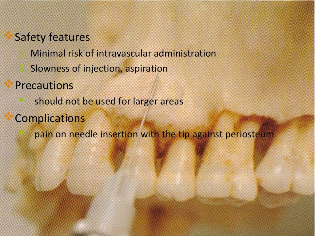 maxillary nerve blocks