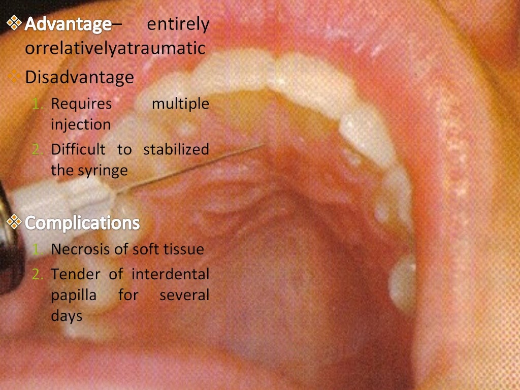 maxillary nerve blocks