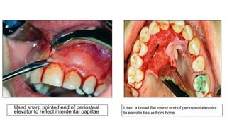 Used sharp pointed end of periosteal
elevator to reflect interdental papillae
Used a broad flat round end of periosteal elevator
to elevate tissue from bone .
 