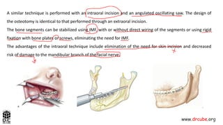 Oral Surgery5 Lec14 Orthognathic Surgery_250424_194204.pdf