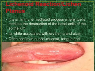 • It is an immune mediated process where Tcells
mediate the destruction of the basal cells of the
epithelium,
• Its while associated with erythema and ulcer
• Often occurs in buccal mucosa, tongue and
gingiva.
 