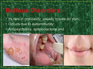• Its rare in oral cavity ,usually occurs on skin.
• Occurs due to autoimmunity
• Antipsychotics .spironolactone and
sulphonamide
•others
 