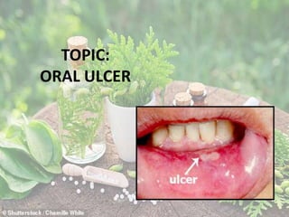 TOPIC:
ORAL ULCER
 