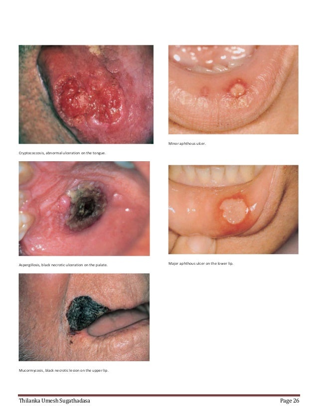 Black Lesion In Mouth 57