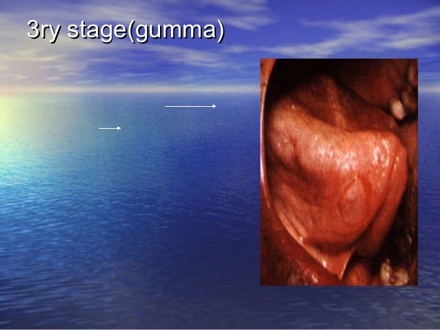 Oral ulcer revision 1