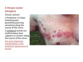 5-Herpes zoster
(shingles)
Clinical picture:
1-Prodrome: 2-4 days
(shooting pain,
paresthesia,burning
sensation) along the
course of the nerve
2-unilateral vesicles on
erythematous base
,appears as clusters along
the course of the nerve.
the most diagnostic
manifestation is the
unilateral appearance of
lesions

 