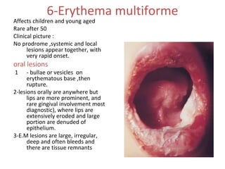 6-Erythema multiforme

Affects children and young aged
Rare after 50
Clinical picture :
No prodrome ,systemic and local
lesions appear together, with
very rapid onset.

oral lesions
1

- bullae or vesicles on
erythematous base ,then
rupture.
2-lesions orally are anywhere but
lips are more prominent, and
rare gingival involvement most
diagnostic), where lips are
extensively eroded and large
portion are denuded of
epithelium.
3-E.M lesions are large, irregular,
deep and often bleeds and
there are tissue remnants

 