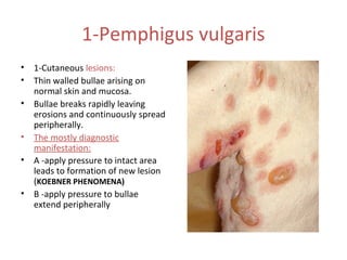 1-Pemphigus vulgaris
•
•
•
•
•
•

1-Cutaneous lesions:
Thin walled bullae arising on
normal skin and mucosa.
Bullae breaks rapidly leaving
erosions and continuously spread
peripherally.
The mostly diagnostic
manifestation:
A -apply pressure to intact area
leads to formation of new lesion
(KOEBNER PHENOMENA)
B -apply pressure to bullae
extend peripherally

 