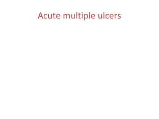 Acute multiple ulcers

 