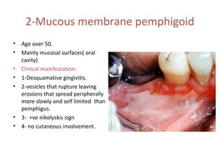 2-Mucous membrane pemphigoid
•
•
•
•
•

•
•

Age over 50.
Mainly mucosal surfaces( oral
cavity)
Clinical manifestation:
1-Desquamative gingivitis.
2-vesicles that rupture leaving
erosions that spread peripherally
more slowly and self limited than
pemphigus.
3- +ve nikolyskis sign
4- no cutaneous involvement.

 