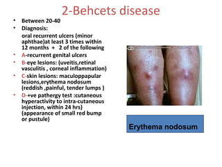 •
•

•
•
•
•

2-Behcets disease

Between 20-40
Diagnosis:
oral recurrent ulcers (minor
aphthae)at least 3 times within
12 months + 2 of the following
A-recurrent genital ulcers
B-eye lesions: (uveitis,retinal
vasculitis , corneal inflammation)
C-skin lesions: maculoppapular
lesions,erythema nodosum
(reddish ,painful, tender lumps )
D-+ve pathergy test :cutaneous
hyperactivity to intra-cutaneous
injection, within 24 hrs)
(appearance of small red bump
or pustule)

Erythema nodosum

 