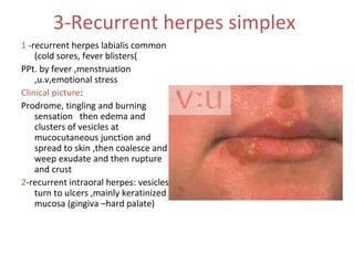 3-Recurrent herpes simplex
1 -recurrent herpes labialis common
(cold sores, fever blisters(
PPt. by fever ,menstruation
,u.v,emotional stress
Clinical picture:
Prodrome, tingling and burning
sensation then edema and
clusters of vesicles at
mucocutaneous junction and
spread to skin ,then coalesce and
weep exudate and then rupture
and crust
2-recurrent intraoral herpes: vesicles
turn to ulcers ,mainly keratinized
mucosa (gingiva –hard palate)

 