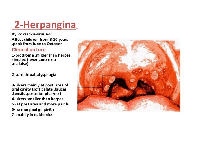 Oral Ulcers