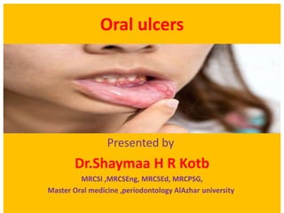 Oral ulcers
Presented by
Dr.Shaymaa H R Kotb
MRCSI ,MRCSEng, MRCSEd, MRCPSG,
university
Master Oral medicine ,periodontology AlAzhar
 