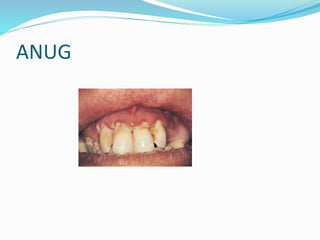 Oral mucosa ulcers.pdf. lecture oral medicine | PDF