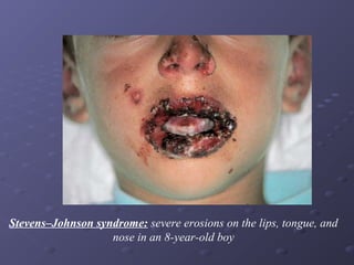 Stevens–Johnson syndrome: severe erosions on the lips, tongue, and
nose in an 8-year-old boy

 