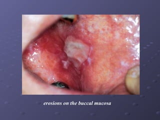 erosions on the buccal mucosa

 