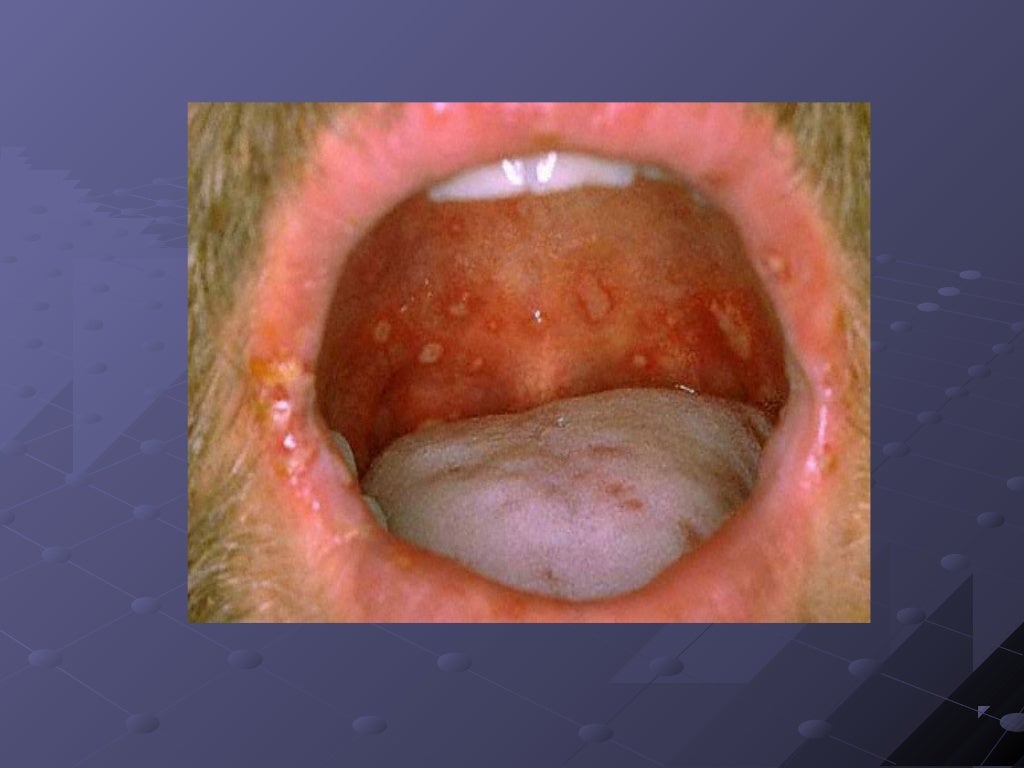 Oral ulcers(collection)