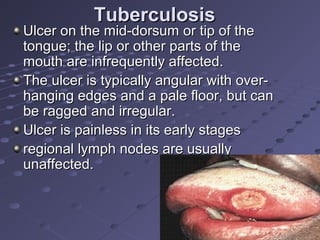 Oral ulcersppt | PPT