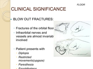 FLOOR

CLINICAL SIGNIFICANCE

   BLOW OUT FRACTURES:

    ◦ Fractures of the orbital floor
    ◦ Infraorbital nerves and
      vessels are almost invariably
      involved

    ◦ Patient presents with
      Diplopia
      Restricted
       movements(upgaze)
      Paresthesia
 