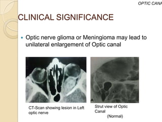 OPTIC CANA


CLINICAL SIGNIFICANCE

   Optic nerve glioma or Meningioma may lead to
    unilateral enlargement of Optic canal




     CT-Scan showing lesion in Left   Strut view of Optic
     optic nerve                      Canal
                                              (Normal)
 