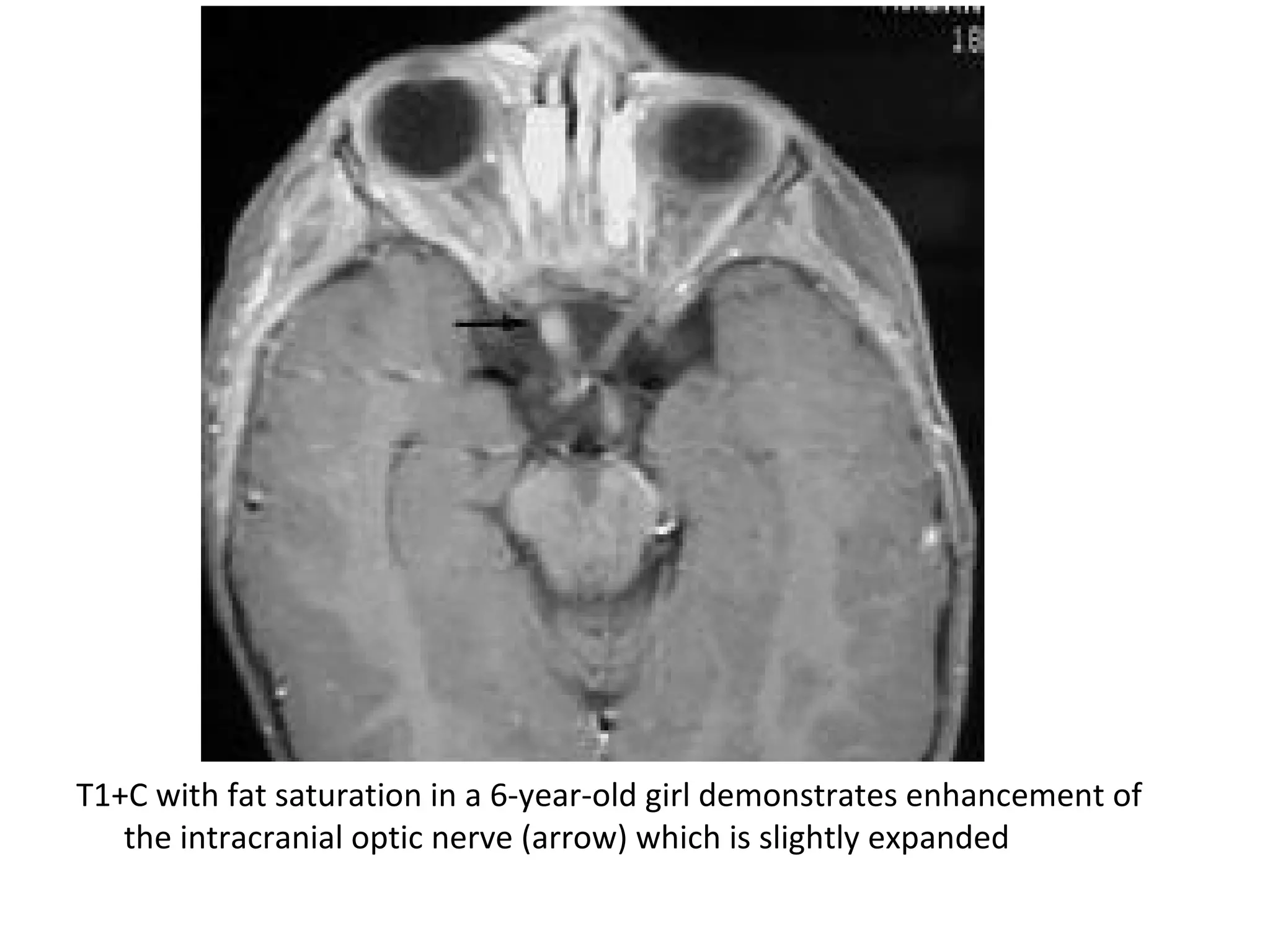 T1+C with fat saturation in a 6-year-old girl demonstrates enhancement of
the intracranial optic nerve (arrow) which is slightly expanded
 