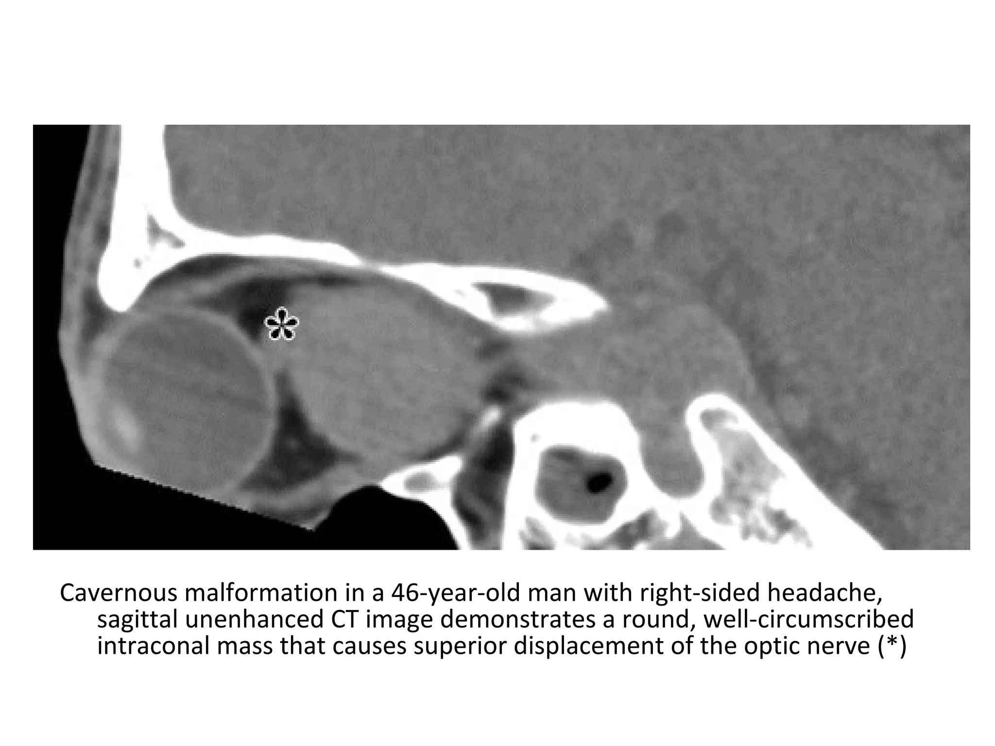 Cavernous malformation in a 46-year-old man with right-sided headache,
sagittal unenhanced CT image demonstrates a round, well-circumscribed
intraconal mass that causes superior displacement of the optic nerve (*)
 
