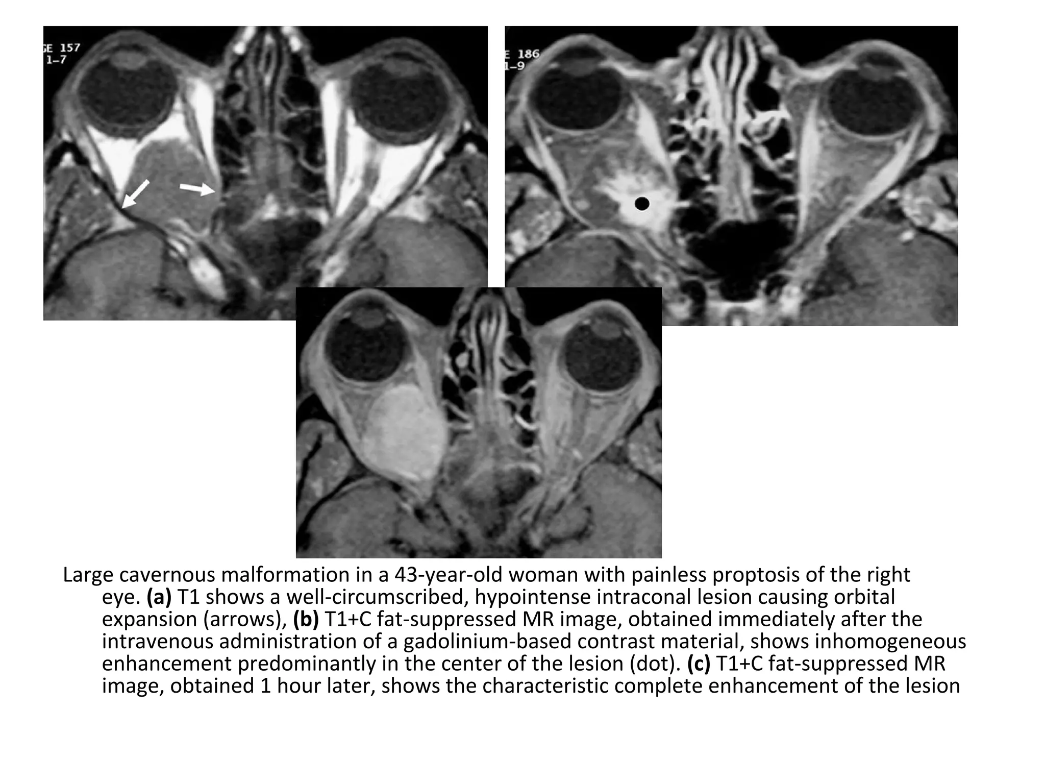 Large cavernous malformation in a 43-year-old woman with painless proptosis of the right
eye. (a) T1 shows a well-circumscribed, hypointense intraconal lesion causing orbital
expansion (arrows), (b) T1+C fat-suppressed MR image, obtained immediately after the
intravenous administration of a gadolinium-based contrast material, shows inhomogeneous
enhancement predominantly in the center of the lesion (dot). (c) T1+C fat-suppressed MR
image, obtained 1 hour later, shows the characteristic complete enhancement of the lesion
 