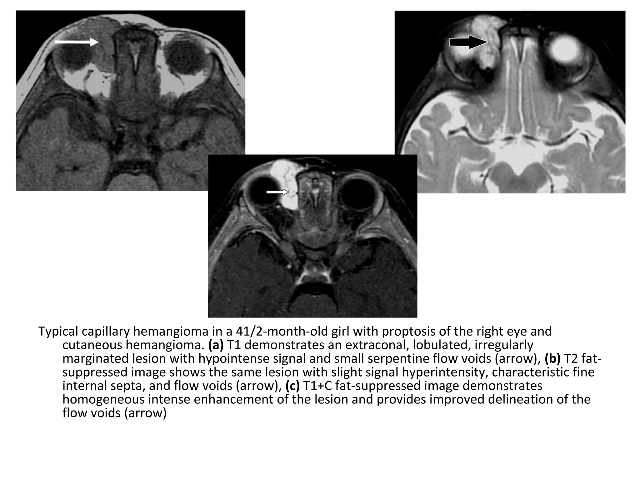 Typical capillary hemangioma in a 41/2-month-old girl with proptosis of the right eye and
cutaneous hemangioma. (a) T1 demonstrates an extraconal, lobulated, irregularly
marginated lesion with hypointense signal and small serpentine flow voids (arrow), (b) T2 fat-
suppressed image shows the same lesion with slight signal hyperintensity, characteristic fine
internal septa, and flow voids (arrow), (c) T1+C fat-suppressed image demonstrates
homogeneous intense enhancement of the lesion and provides improved delineation of the
flow voids (arrow)
 