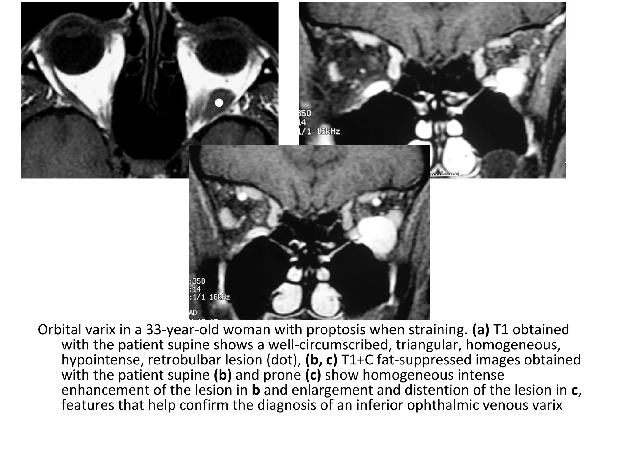 Orbital varix in a 33-year-old woman with proptosis when straining. (a) T1 obtained
with the patient supine shows a well-circumscribed, triangular, homogeneous,
hypointense, retrobulbar lesion (dot), (b, c) T1+C fat-suppressed images obtained
with the patient supine (b) and prone (c) show homogeneous intense
enhancement of the lesion in b and enlargement and distention of the lesion in c,
features that help confirm the diagnosis of an inferior ophthalmic venous varix
 