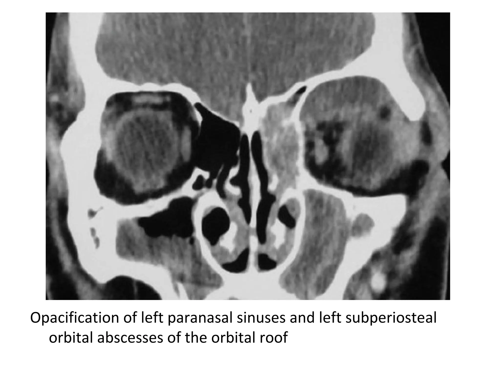 Opacification of left paranasal sinuses and left subperiosteal
orbital abscesses of the orbital roof
 