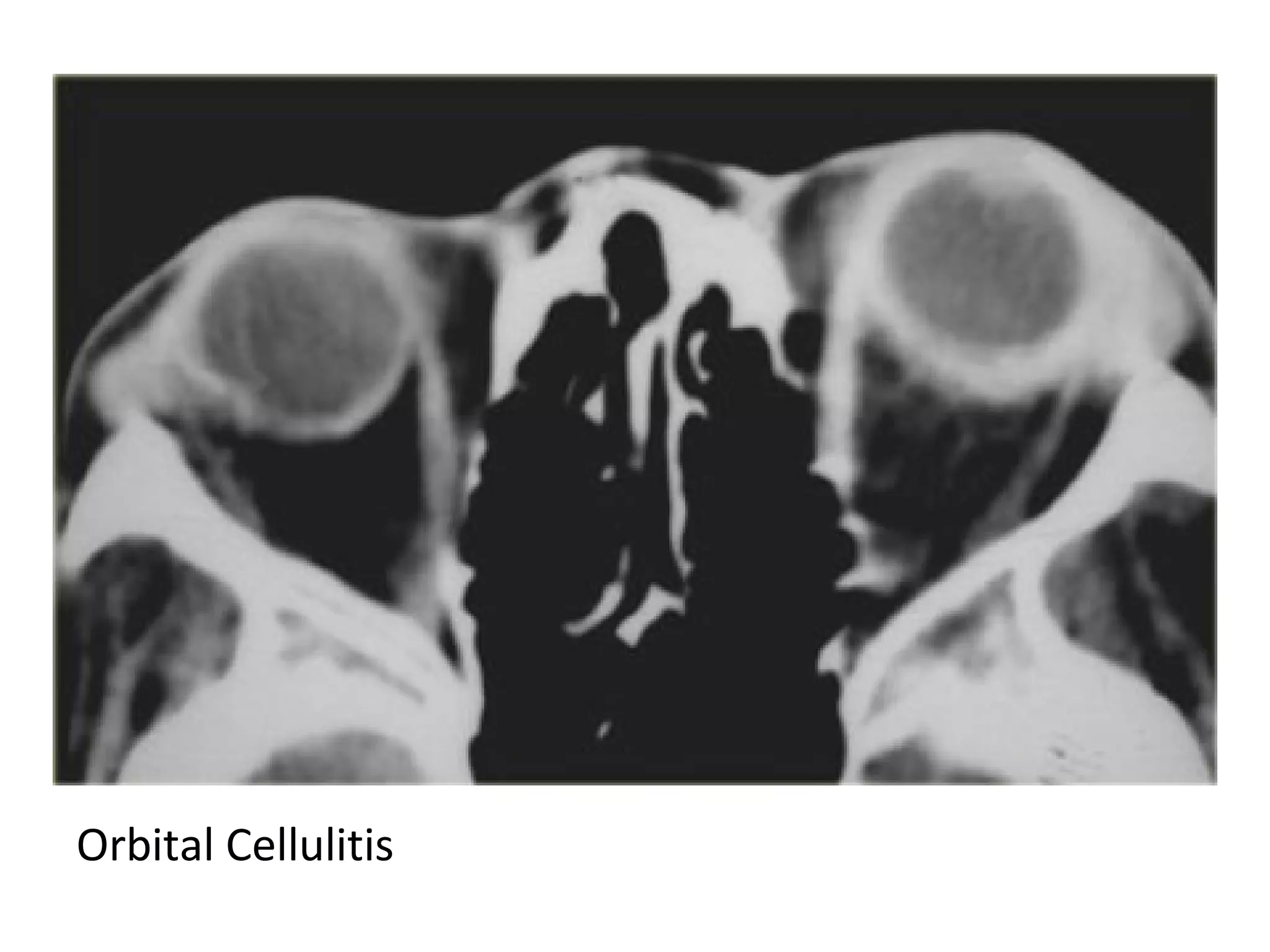 Orbital Cellulitis
 