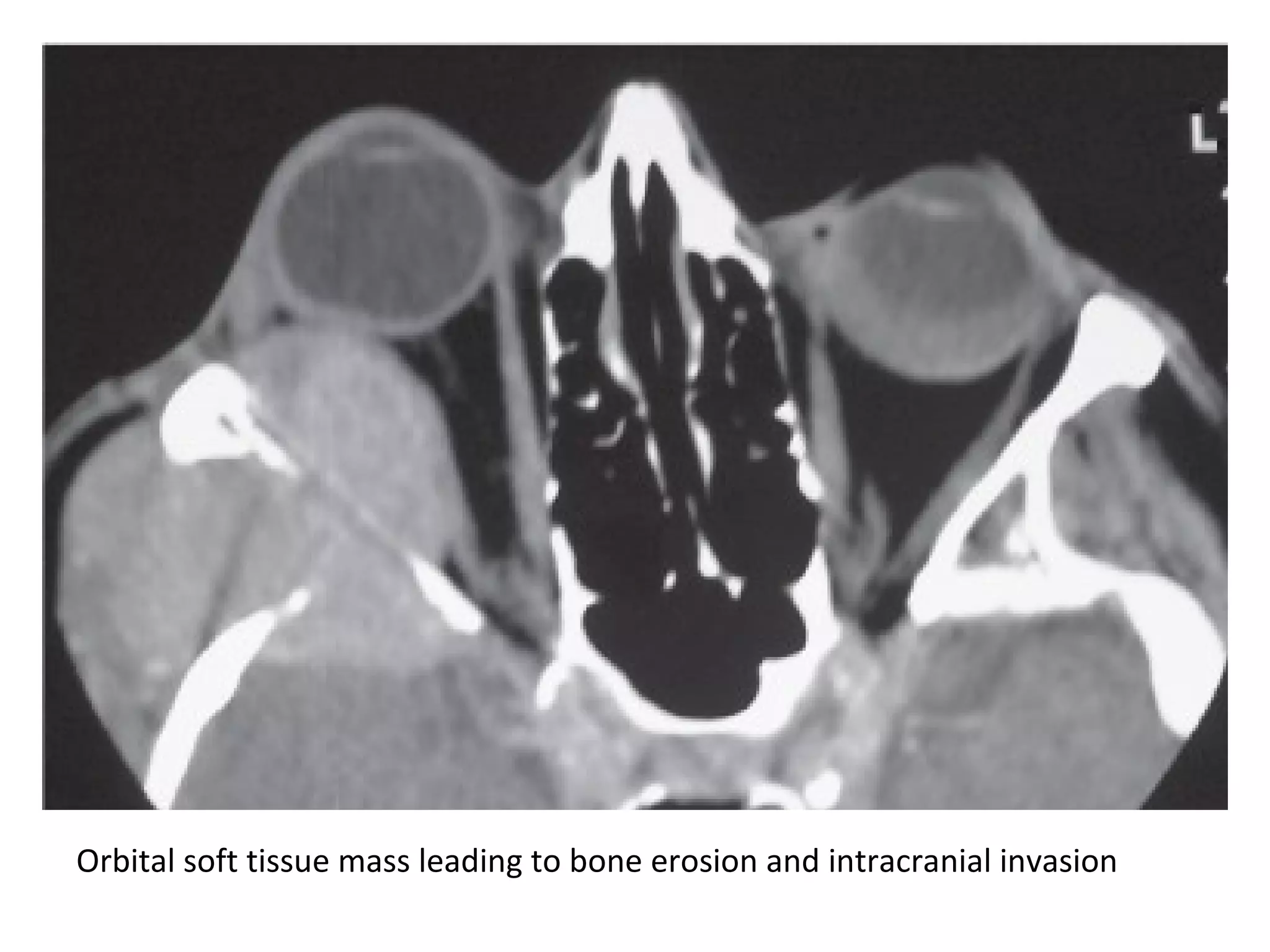 Orbital soft tissue mass leading to bone erosion and intracranial invasion
 