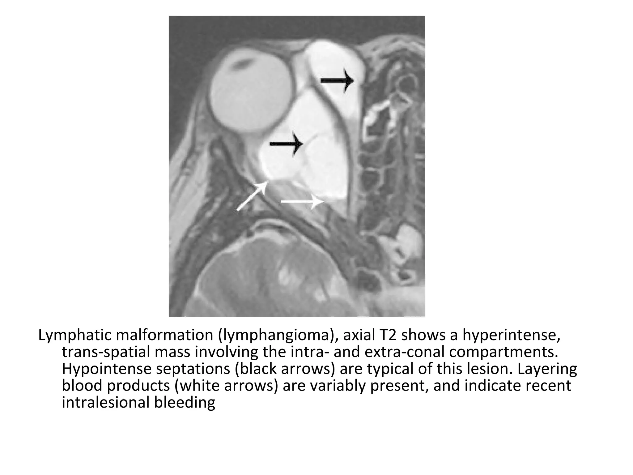 Lymphatic malformation (lymphangioma), axial T2 shows a hyperintense,
trans-spatial mass involving the intra- and extra-conal compartments.
Hypointense septations (black arrows) are typical of this lesion. Layering
blood products (white arrows) are variably present, and indicate recent
intralesional bleeding
 