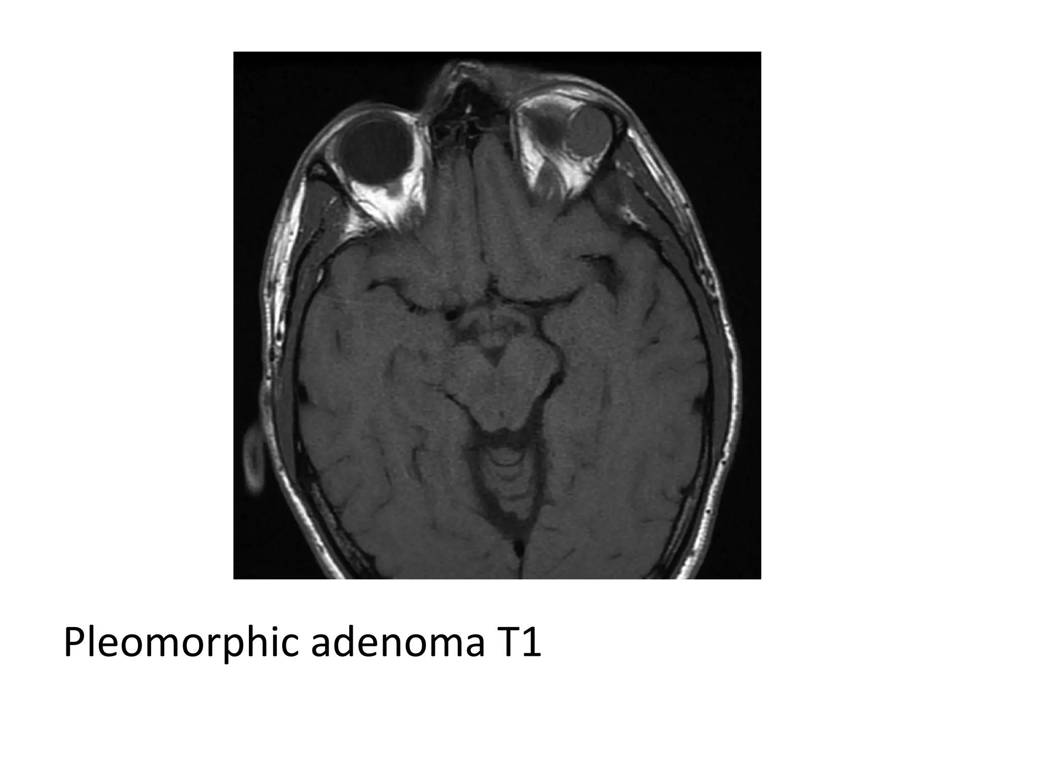 Pleomorphic adenoma T1
 