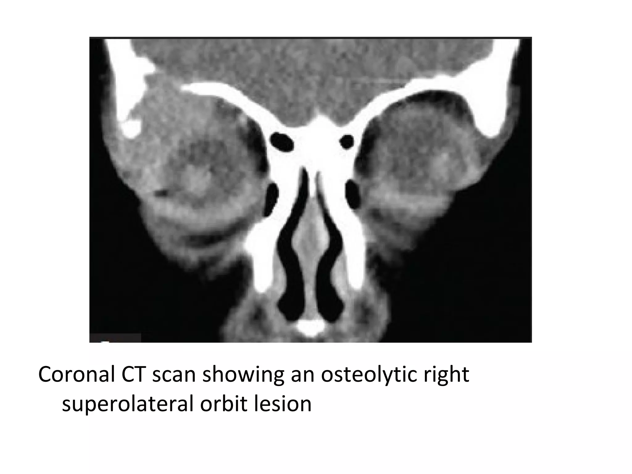 Coronal CT scan showing an osteolytic right
superolateral orbit lesion
 