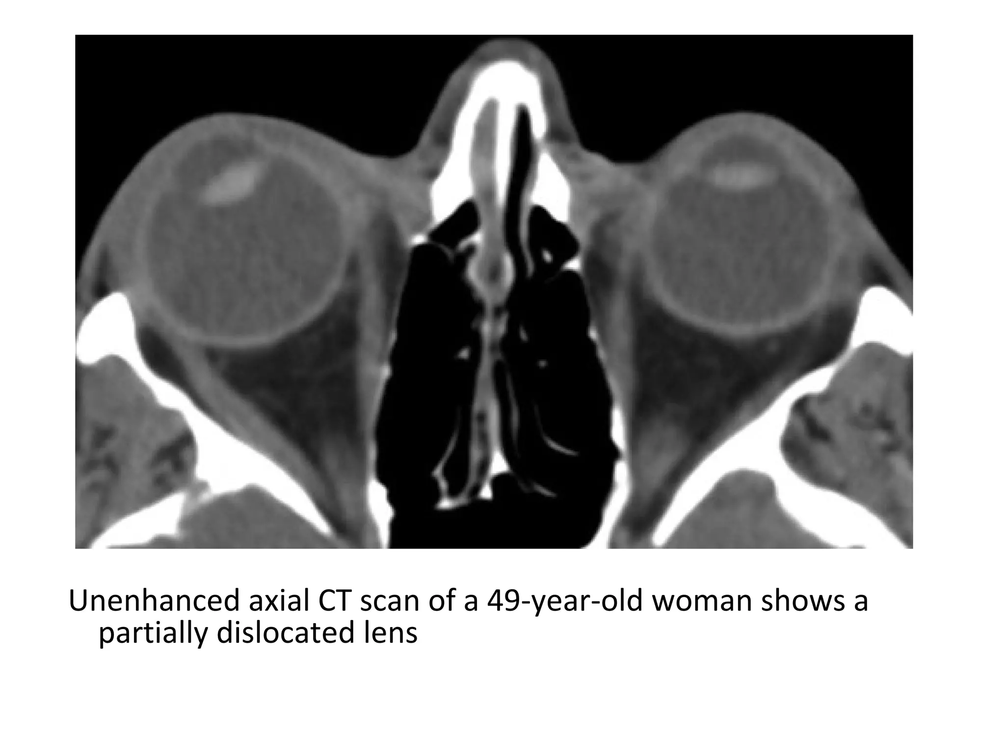 Unenhanced axial CT scan of a 49-year-old woman shows a
partially dislocated lens
 