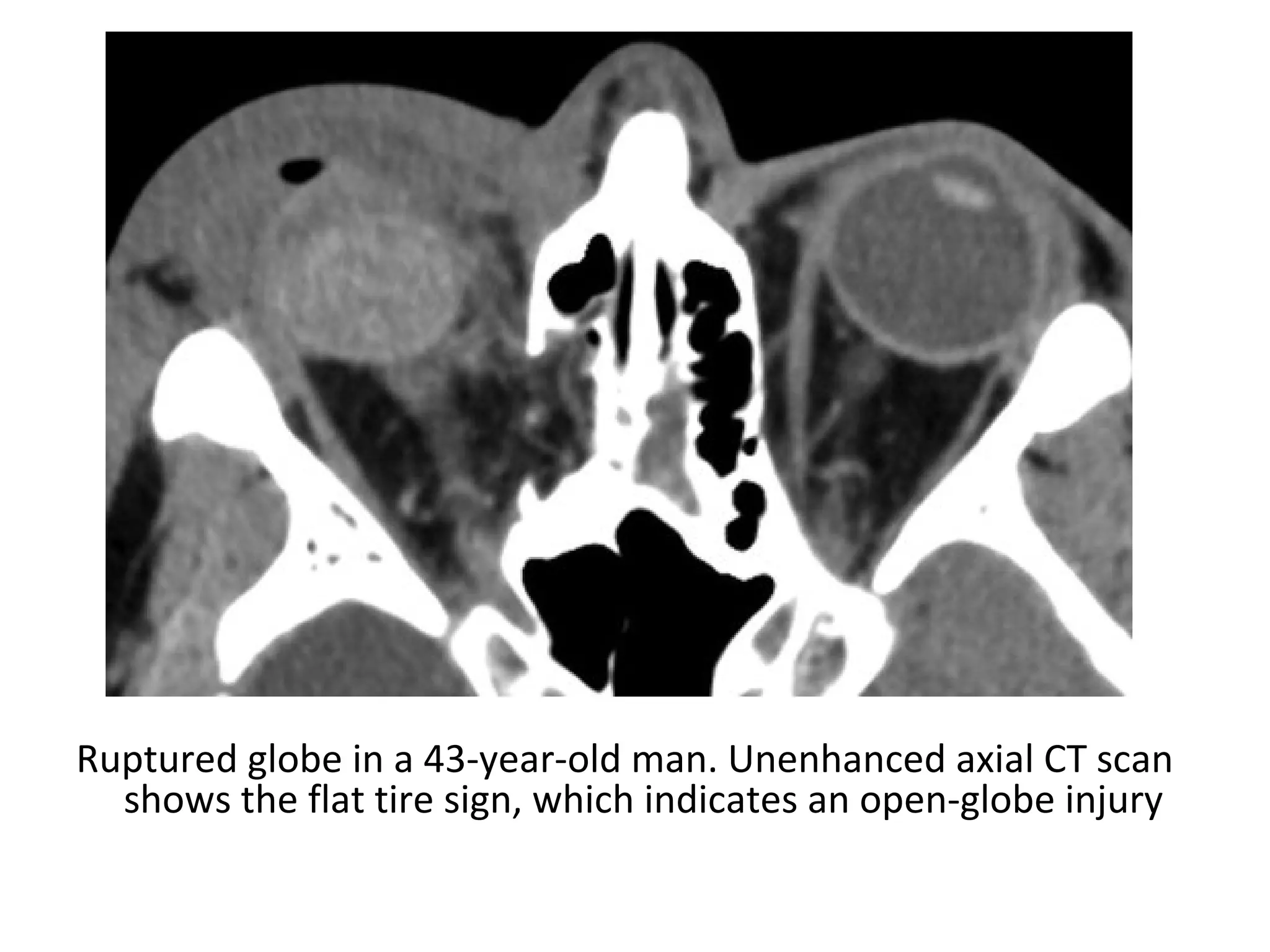 Ruptured globe in a 43-year-old man. Unenhanced axial CT scan
shows the flat tire sign, which indicates an open-globe injury
 