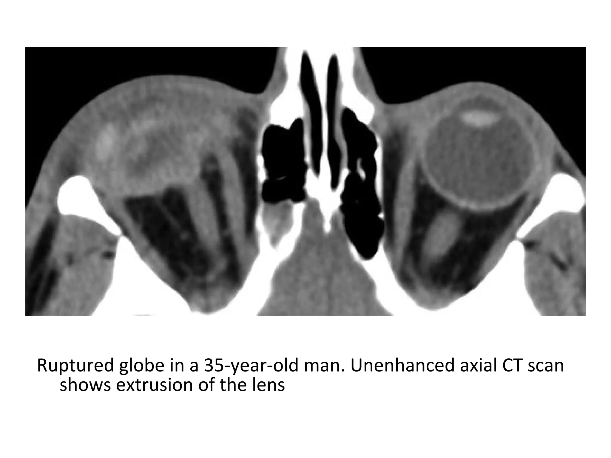 Ruptured globe in a 35-year-old man. Unenhanced axial CT scan
shows extrusion of the lens
 