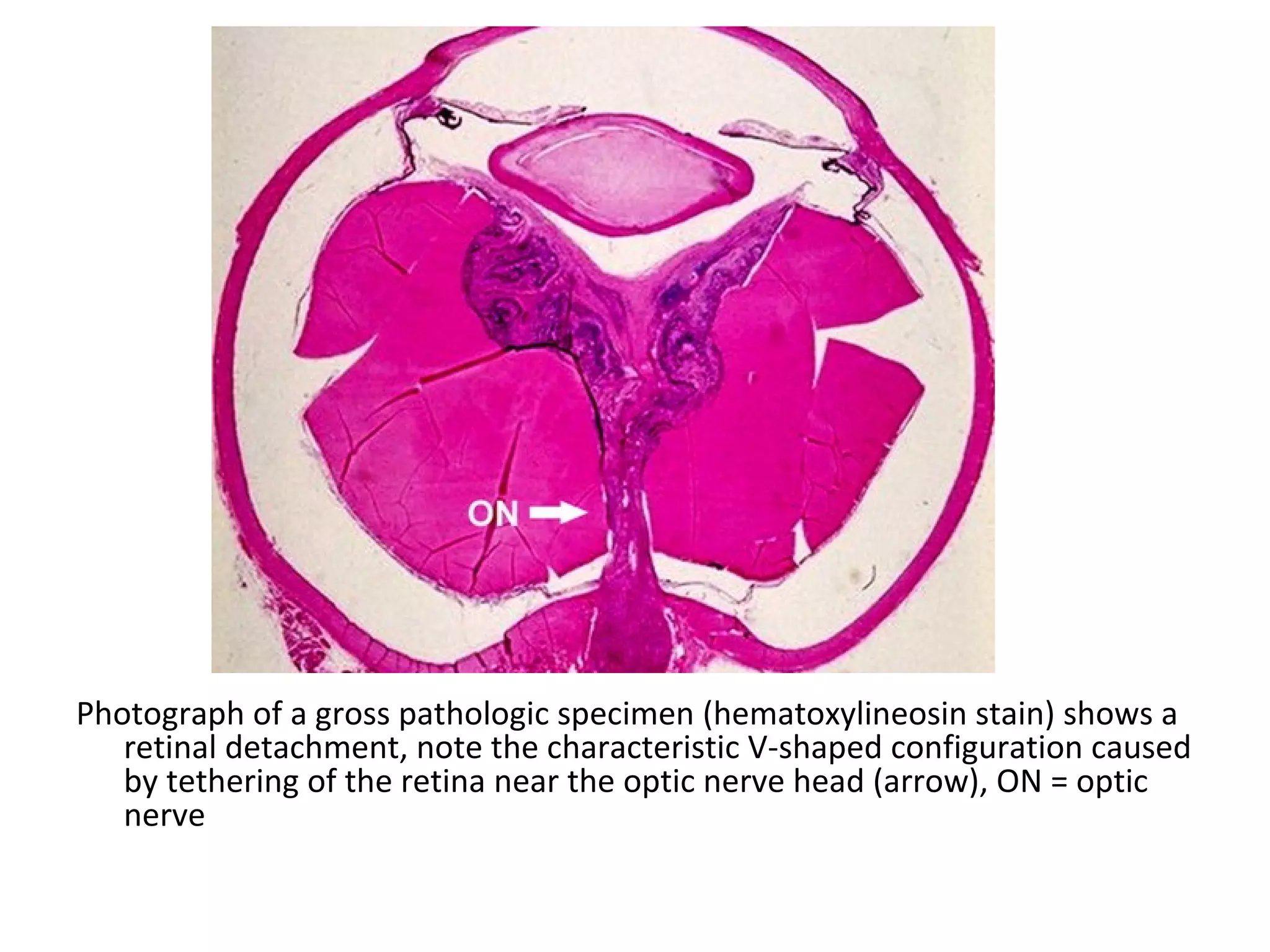 Photograph of a gross pathologic specimen (hematoxylineosin stain) shows a
retinal detachment, note the characteristic V-shaped configuration caused
by tethering of the retina near the optic nerve head (arrow), ON = optic
nerve
 
