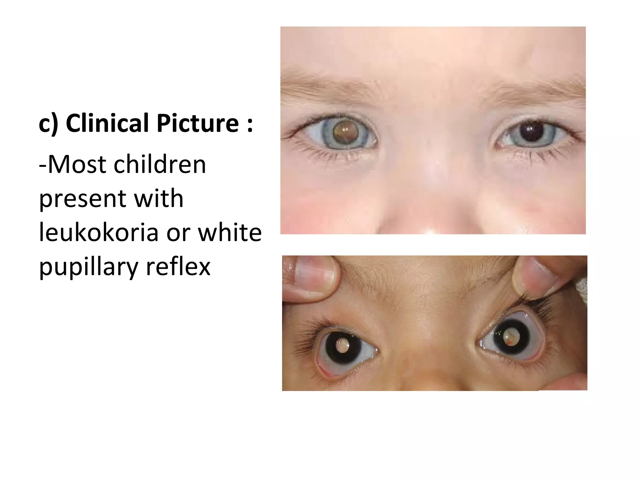 c) Clinical Picture :
-Most children
present with
leukokoria or white
pupillary reflex
 